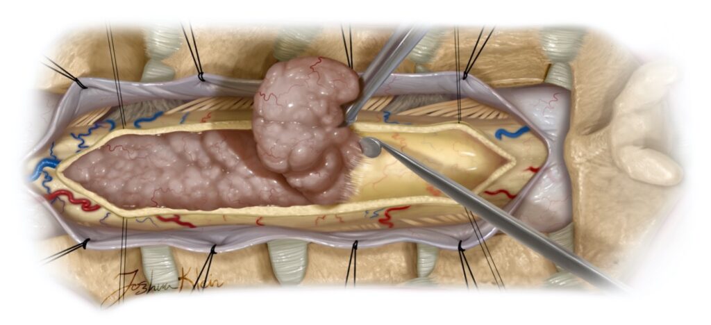 SpinalCordTumorArt1Pic1