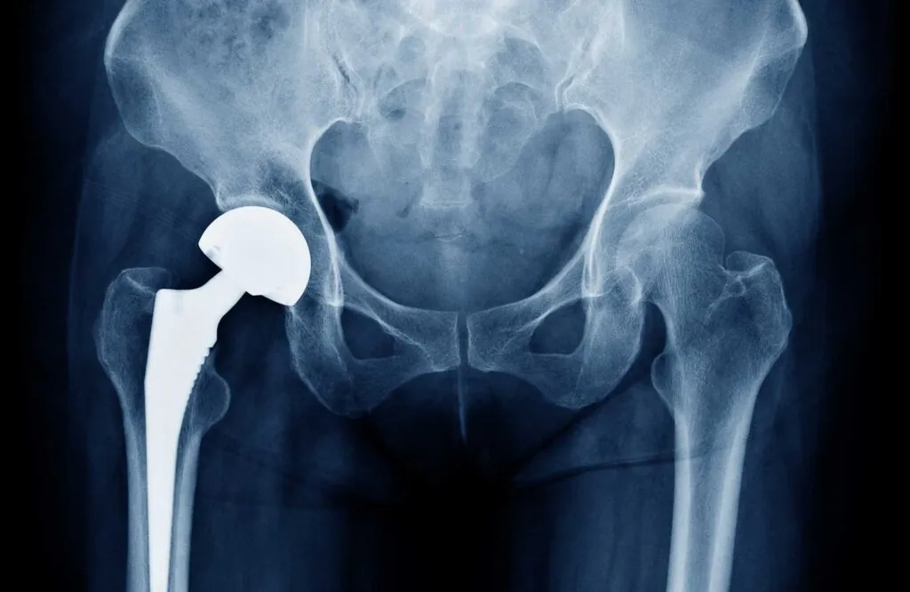 Damaged hip joint before and after replacement
