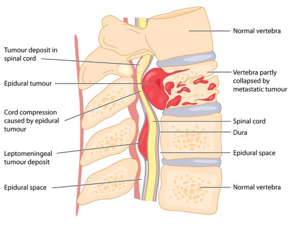 spine tumor 1